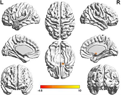 Cognitive decline in acoustic neuroma patients: An investigation based on resting-state functional magnetic resonance imaging and voxel-based morphometry